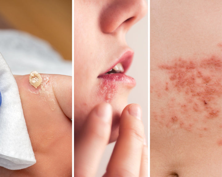 Come curare le lesioni virali: guida ai trattamenti topici (e naturali)