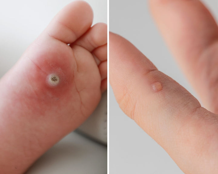 Come eliminare le verruche? Trattamenti naturali vs terapie fisiche cosa scegliere.