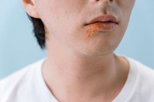 Herpes labiale e la carenza di vitamine